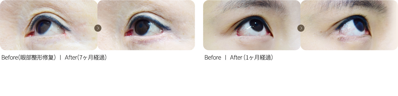 眼尾修复 + 可爱眼延长术