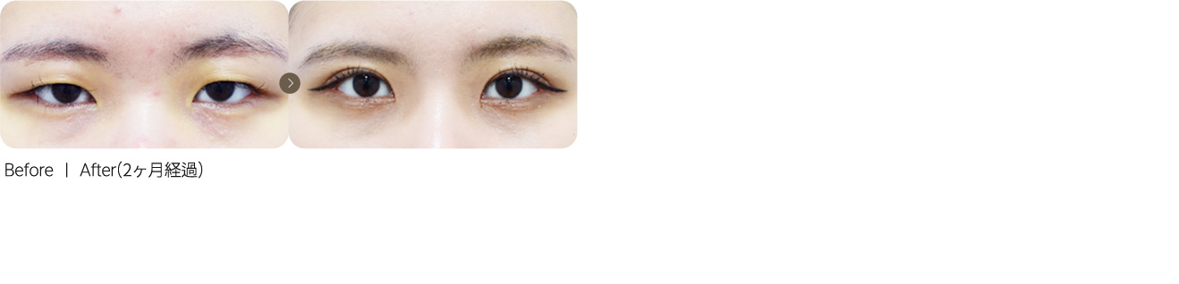 切开矫正 + 开内眼角