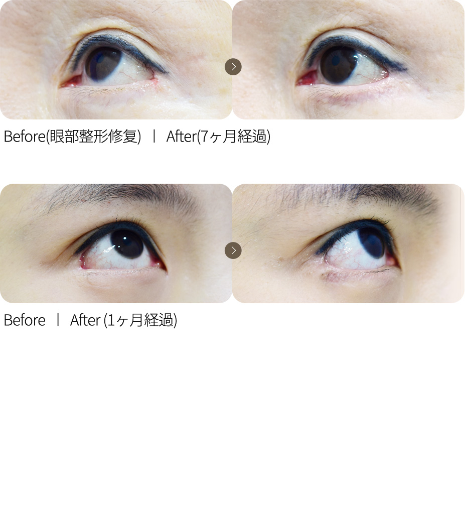 眼尾修复 + 可爱眼延长术