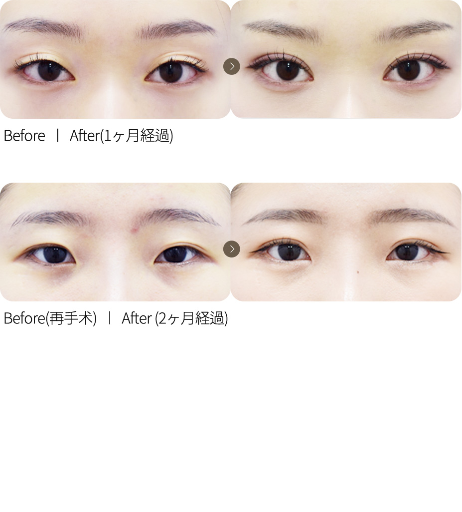 自然粘连双眼皮