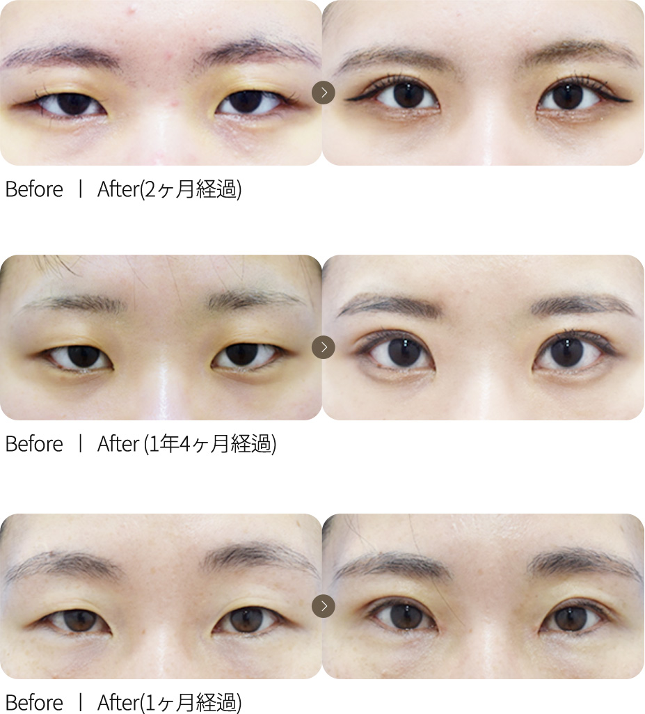 切开矫正 + 开内眼角