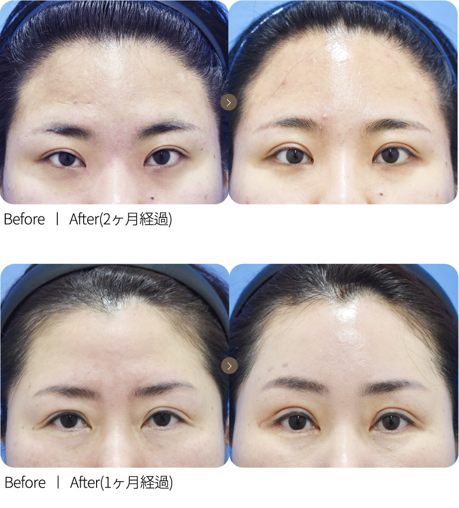 切开手术+额头提升