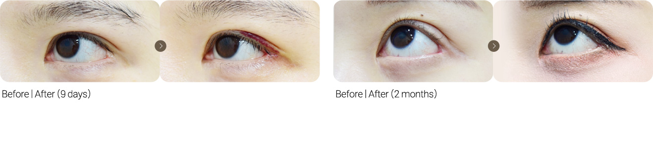 Lateral Canthoplasty Revision