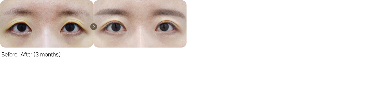 Incisional Revision + Fat Grafting for Hollow Eyes