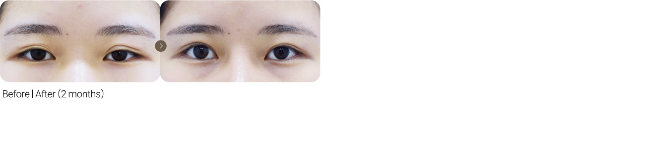 Lower Line Adjustment