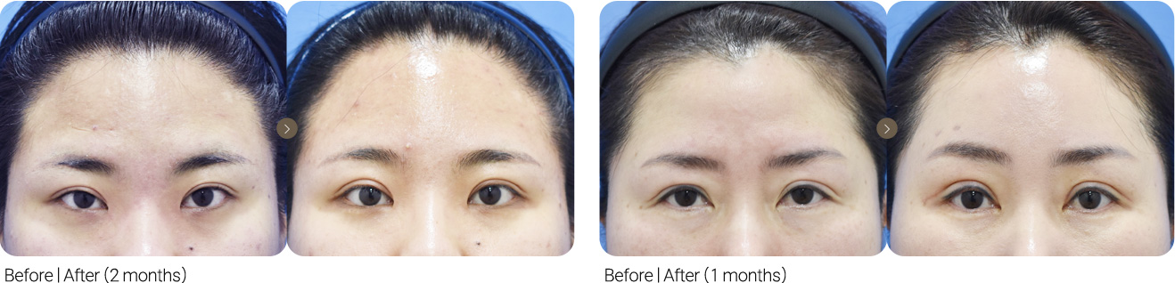 Incisional Surgery + Forehead Lift