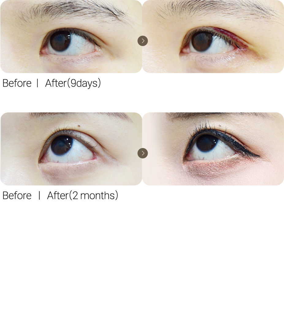 Lateral Canthoplasty Revision