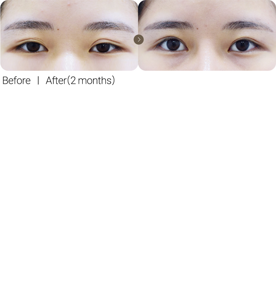 Lower Line Adjustment