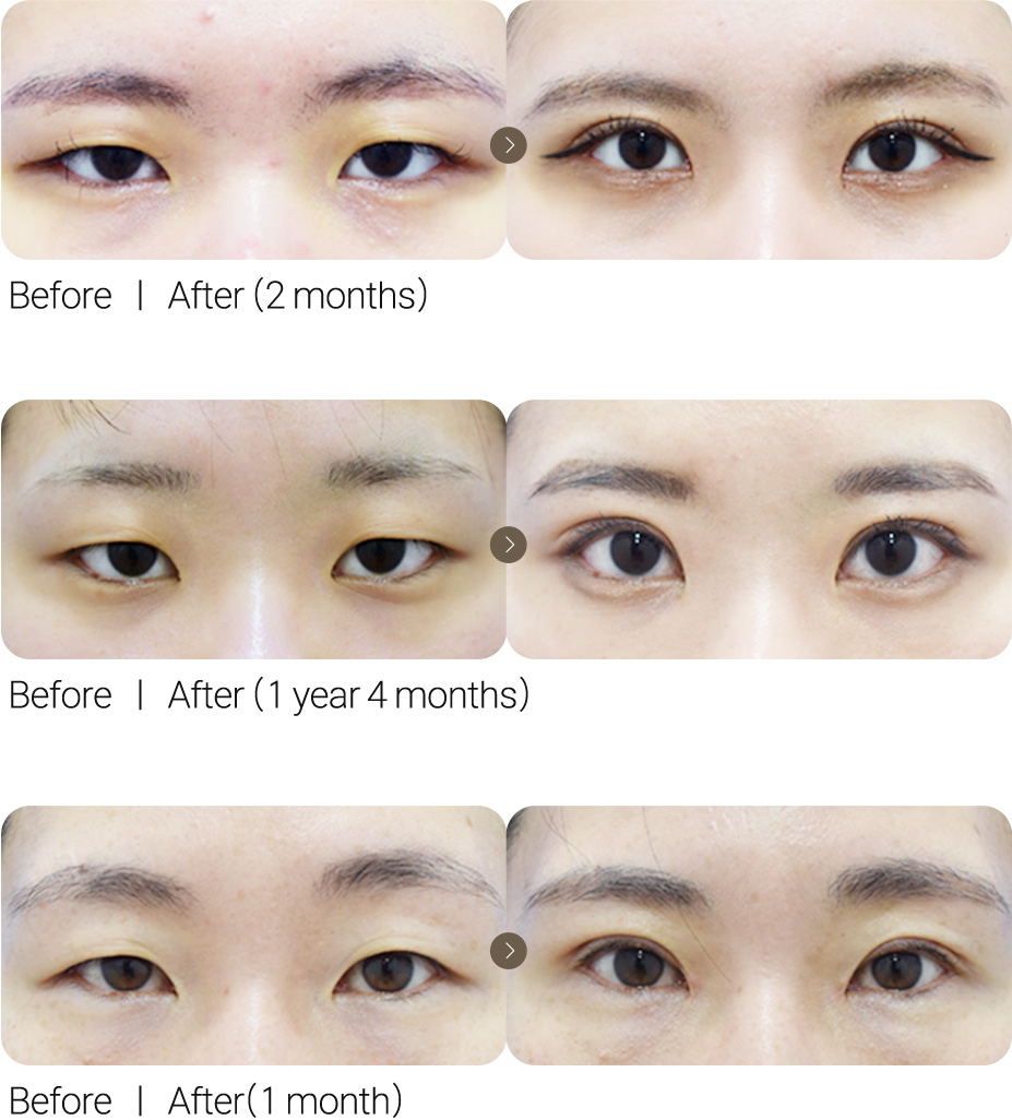 Incisional Eye Correction + Epicanthoplasty