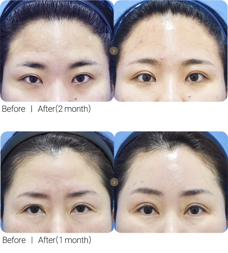 Incisional Surgery + Forehead Lift