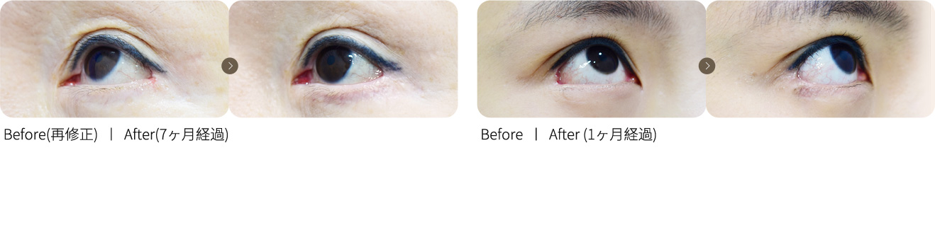 目尻再修正＋ラブリー切開