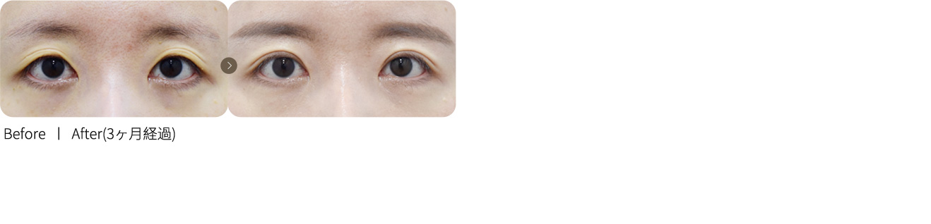 切開法再手術＋くぼみ目脂肪移植