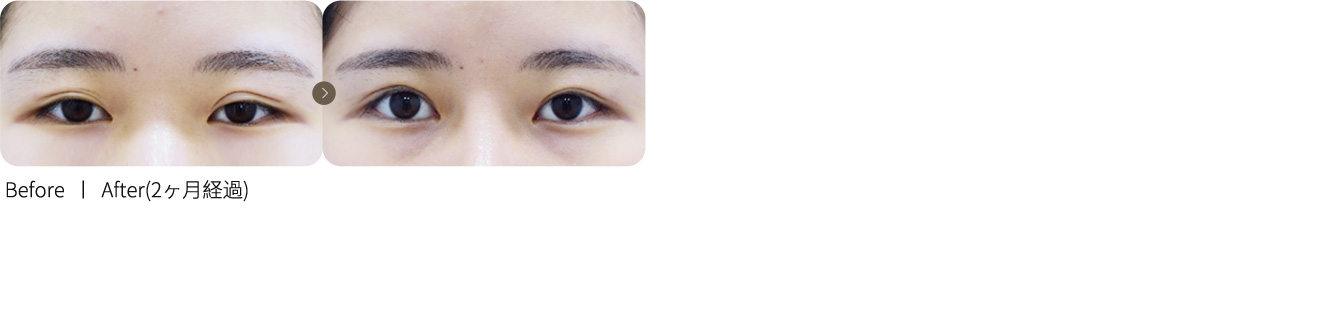 ラインを下げる施術