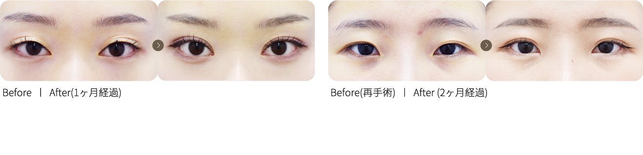 自然癒着二重整形