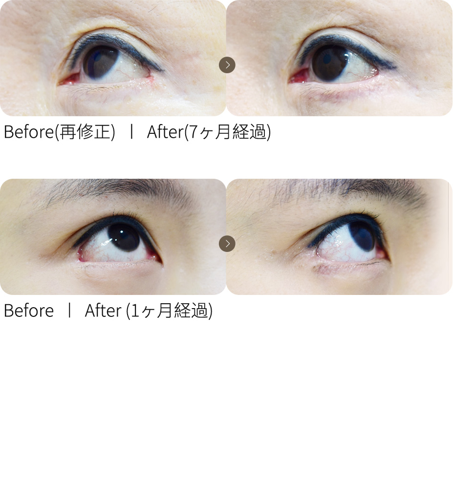 目尻再修正＋ラブリー切開