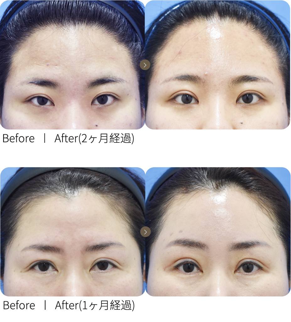 切開手術＋額リフト