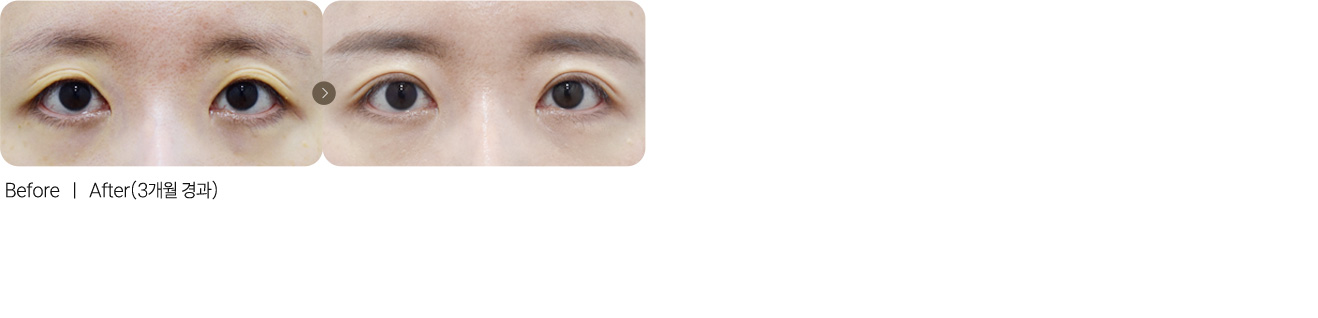 절개재수술+꺼진눈지방이식