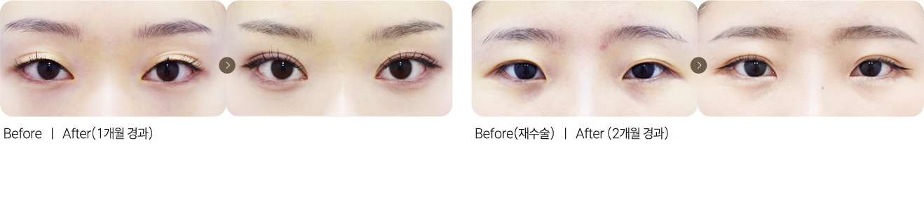 자연유착쌍꺼풀