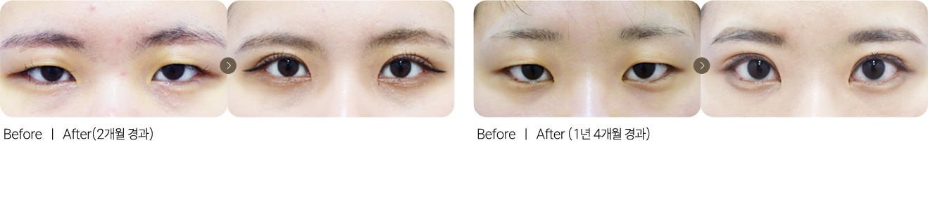 절개눈매교정+앞트임